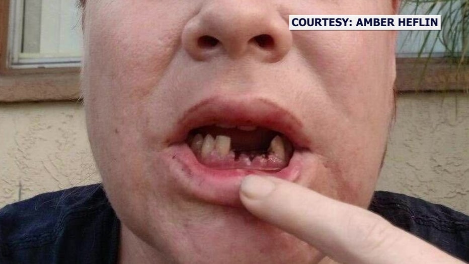 The damage to Heflin's teeth, which a dentist told her would cost around $15,000 to repair.