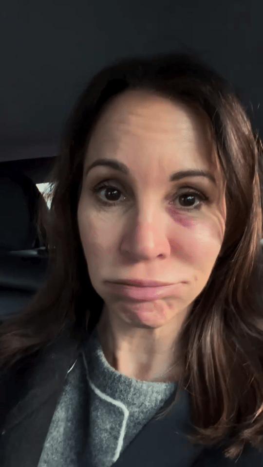 Woman with a black eye.